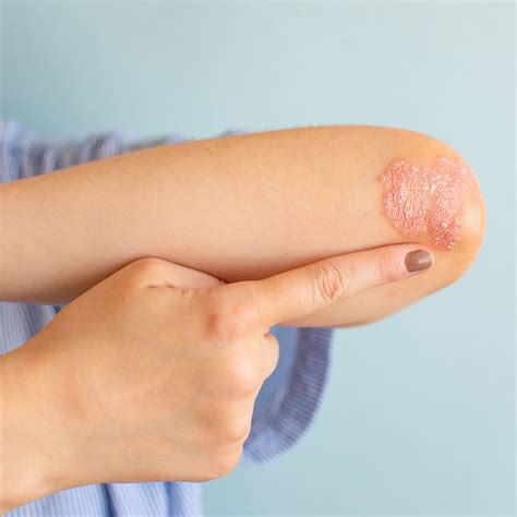 What is Psoriasis? - Lavender Whisper Apothecary