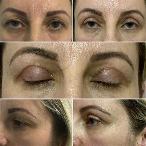 Blefaroplastika – Plava Medical Group