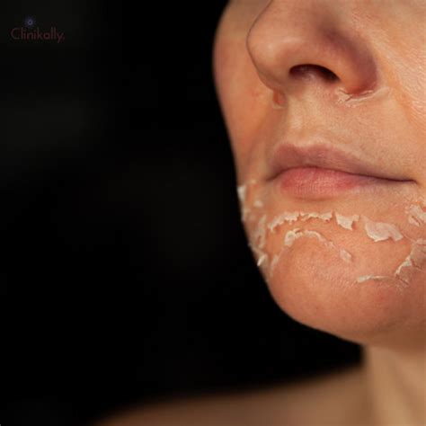 Flaky Skin: Causes and Types| Clinikally