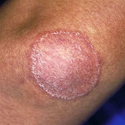 tinea corporis symptoms  treatment