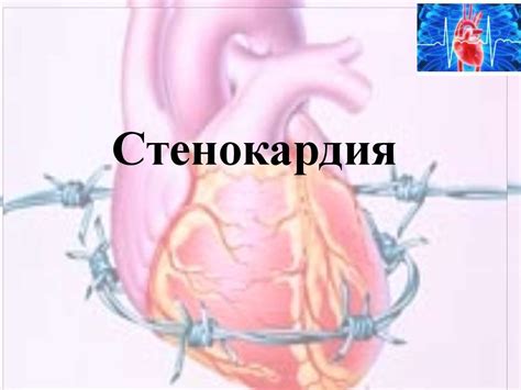 Стенокардия - презентация онлайн