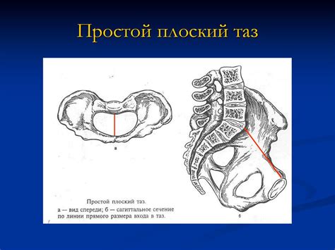 Анатомически и клинически узкий таз у женщины - презентация онлайн