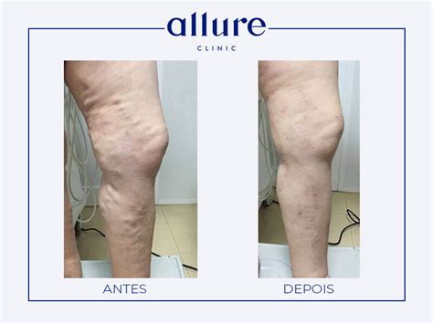 Como Fica A Perna Depois Da Cirurgia De Varizes - Varizes e Derrames nas pernas: Tratamento clínica Allure | Porto