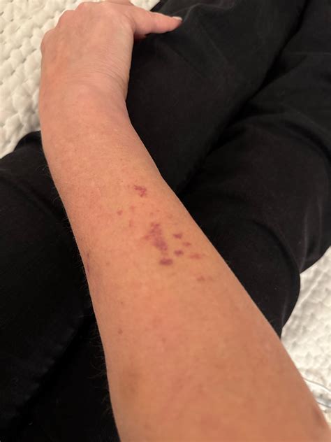 Petechiae On Arms