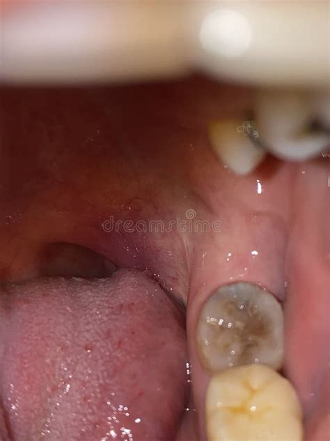 removable partial denture   upper part  tooth stock image