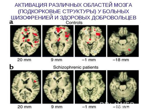Презентация на тему "Шизофрения" - скачать презентации по Медицине
