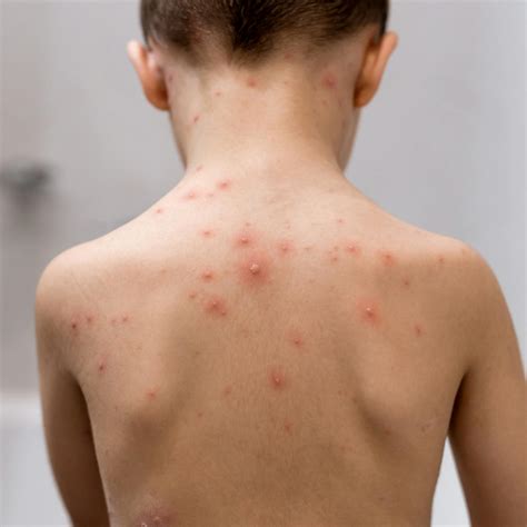 itchy rash  fever learn   chickenpox fluent health