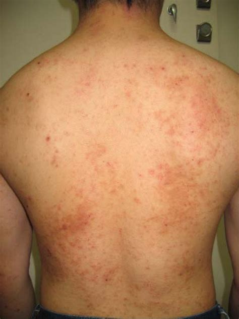 Eczema on the patient's back photographed on day 5. | Download ...