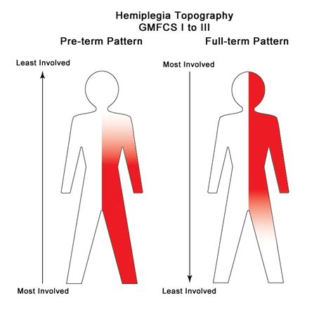 hemiplegia-severity-4-boards | Cerebral palsy, Lettering, Pattern