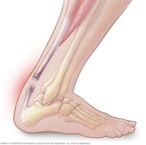 Tendon Rupture | Sports Blog