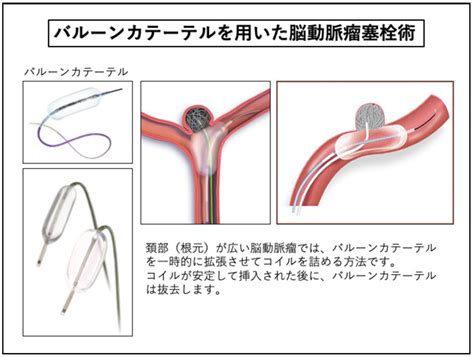 脳血管内治療センター-聖マリアンナ医科大学脳血管内治療科