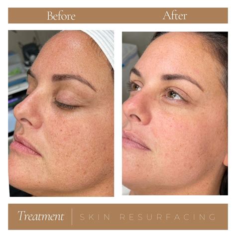 Skin Resurfacing: Before and After — Elivate Wellness