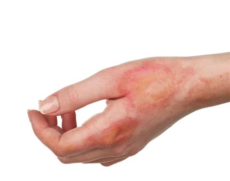 First Aid for Burns: Classification and Treatment