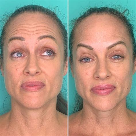 Will Botox Make Me Look Weird? | Glowday