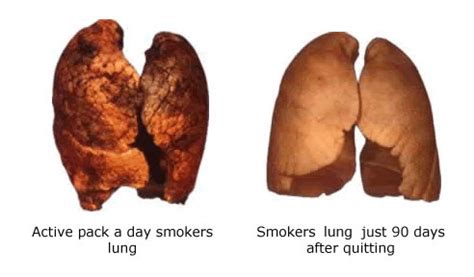 Lungs After Smoking Before And After