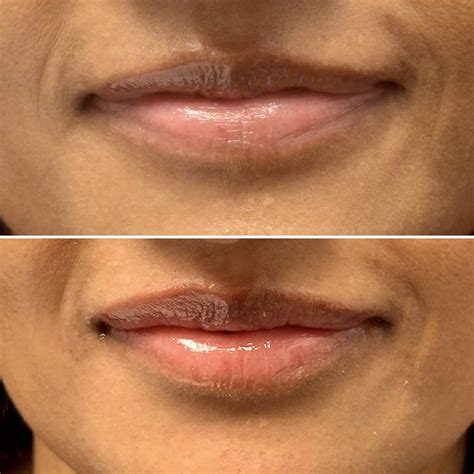 patient outcomes  newport beach balanced skin