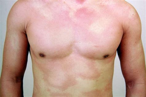 11 Types of Drug Rash (and Medications that Can Cause Them)