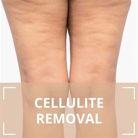 cellulite   microneedling treatments mucmv
