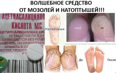 КОПЕЕЧНОЕ СРЕДСТВО ОТ МОЗОЛЕЙ И НАТОПТЫШЕЙ
