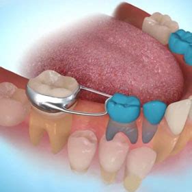Patient Guides | Melbourne Specialist Orthodontist | Angle House