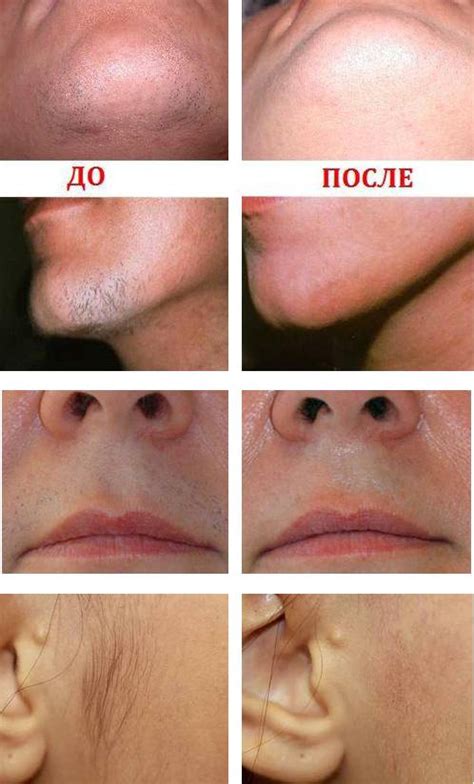 Удаление волос на лице: обзор лучших методов + отзывы