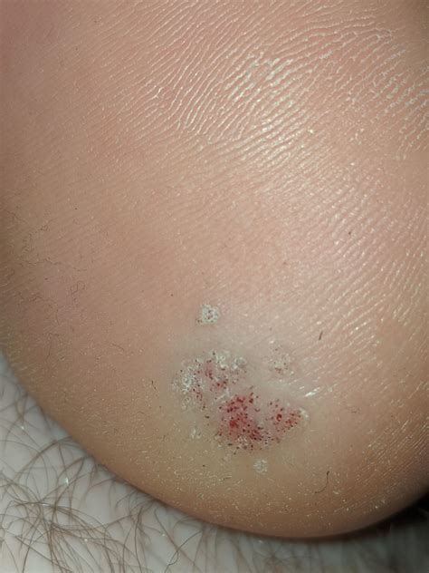 Heel callus confirmed by foot doctor, been cut out, came back, and is