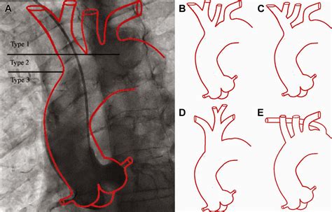 HealthforHeart: Aortic arch anatomy variations in human