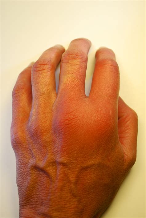 Bee Sting Allergy Reactions - Are You Allergic to Bee Stings?