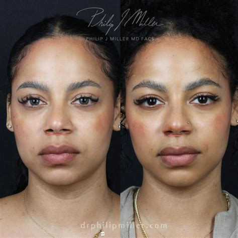 Patient 201060187 | Alar Base Reduction Before & After Photos | Philip ...