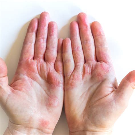 hand eczema solutions