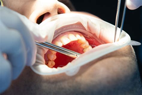 how long does it take to recover wisdom teeth removal