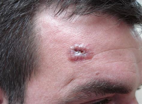 Basal Cell Carcinoma - Causes, Types, Symptoms, Prognosis, Treatment