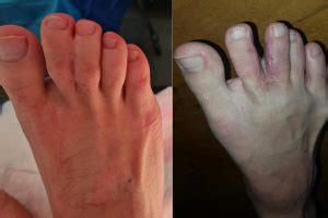 Syndactyly – (Webbed Toes) | Foot & Podiatry Surgery