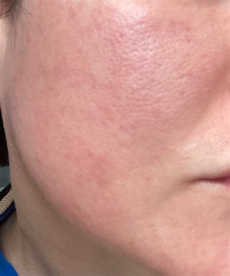 skin  red  patchy rplusskincare