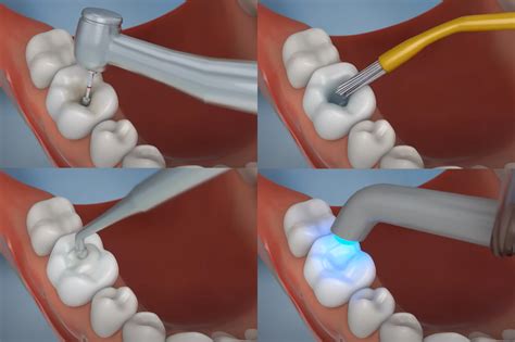 Benefits of Choosing a Composite Filling for Your Smile