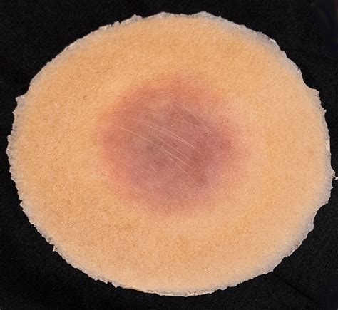 stage  pressure injury techline trauma