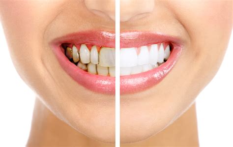 Что такое зубной камень? - DentaGuard