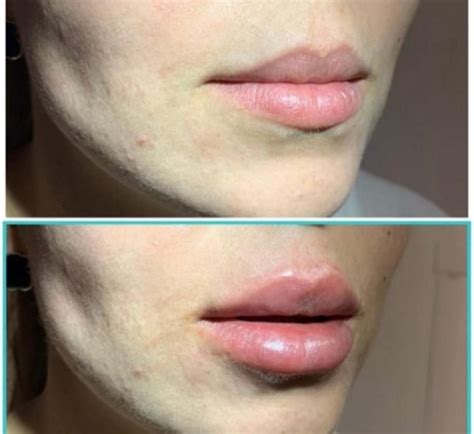 Before and After Lip Injections