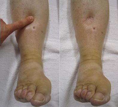 Anasarca: Causes, treatment, and definition
