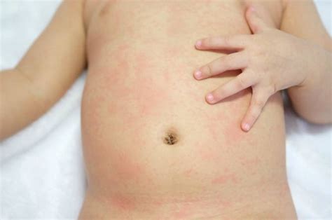 Water Birth: Baby Develops Rash, Almost Dies Of Infection