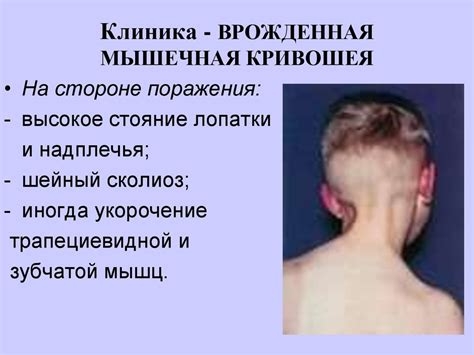 Кривошея - презентация онлайн