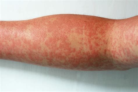 Como É A Mancha Da Dengue