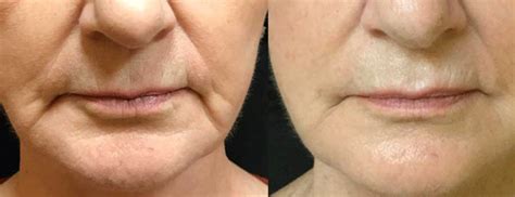 Nasolabial Fold Best Treatments For Nasolabial Folds And Marionette