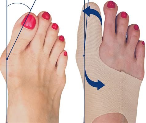 buy bunion corrector  women big toe straightener ultra thin bunion