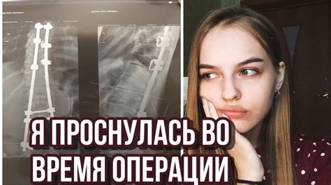 РЕАБИЛИТАЦИЯ после ОПЕРАЦИИ на сколиоз 4 степени/ мой опыт - YouTube