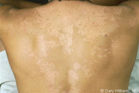 pityriasis versicolor treatment - pictures, photos