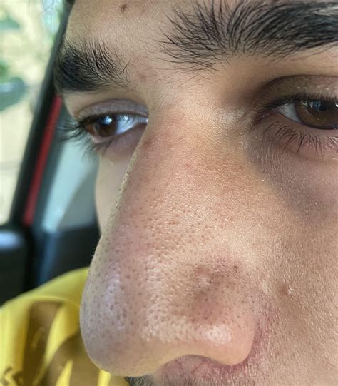 Dermatologists explain the science behind those stubborn big blackheads 6