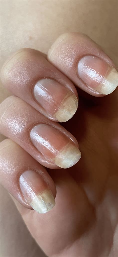 Mild Nail Pitting? : r/PsoriaticArthritis