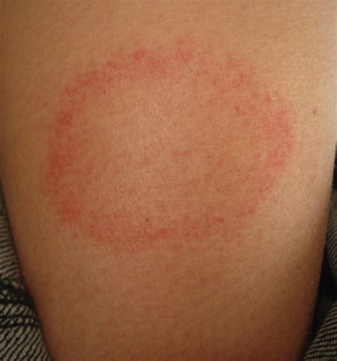 annular rash lupus