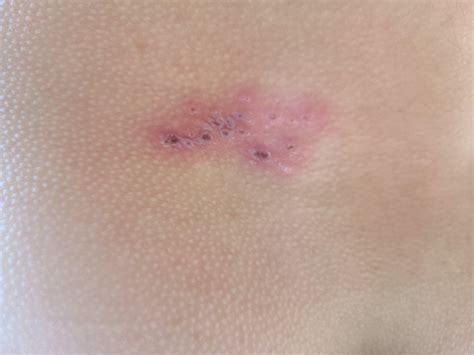 These patches of post burn blister looking things suddenly appeared on